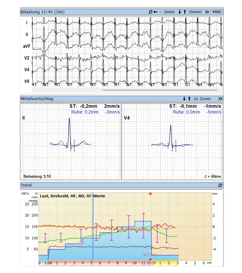 Belastungsuntersuchungen in der Kardiologie