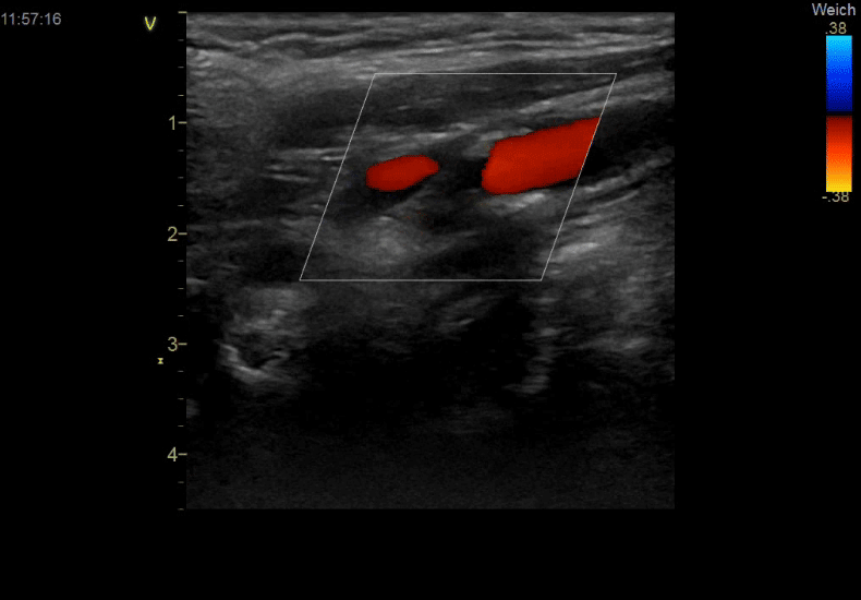 Duplexsonographie der extrakraniellen Hirngefäße