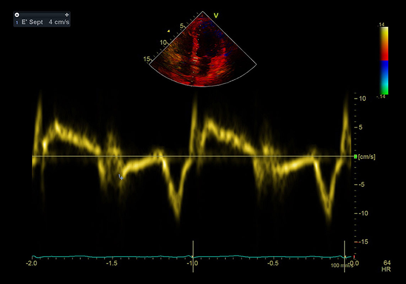 kardiologie Echokardiographie Text II