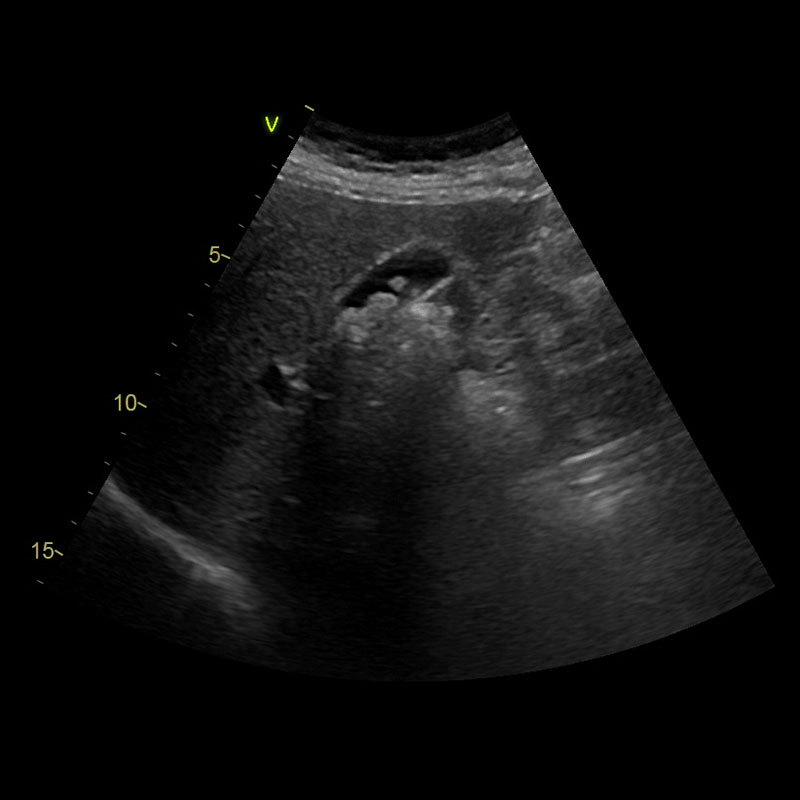 Ultraschall Oberbauch
