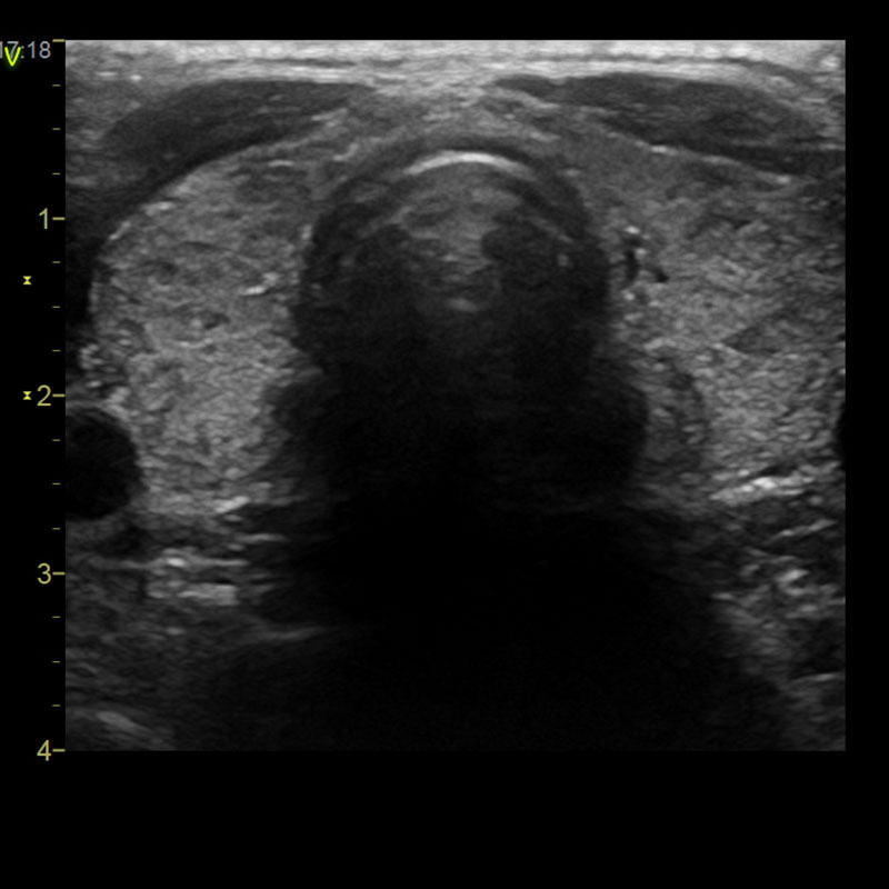 Ultraschall Schilddrüse